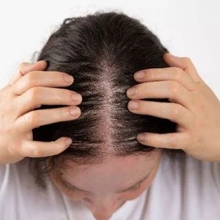 Androgenetic alopecia (male/female pattern baldness)
