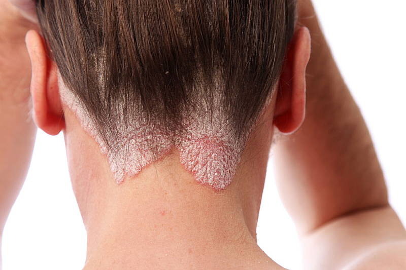 Tinea capitis (scalp ringworm)
