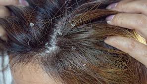Seborrheic dermatitis (dandruff)