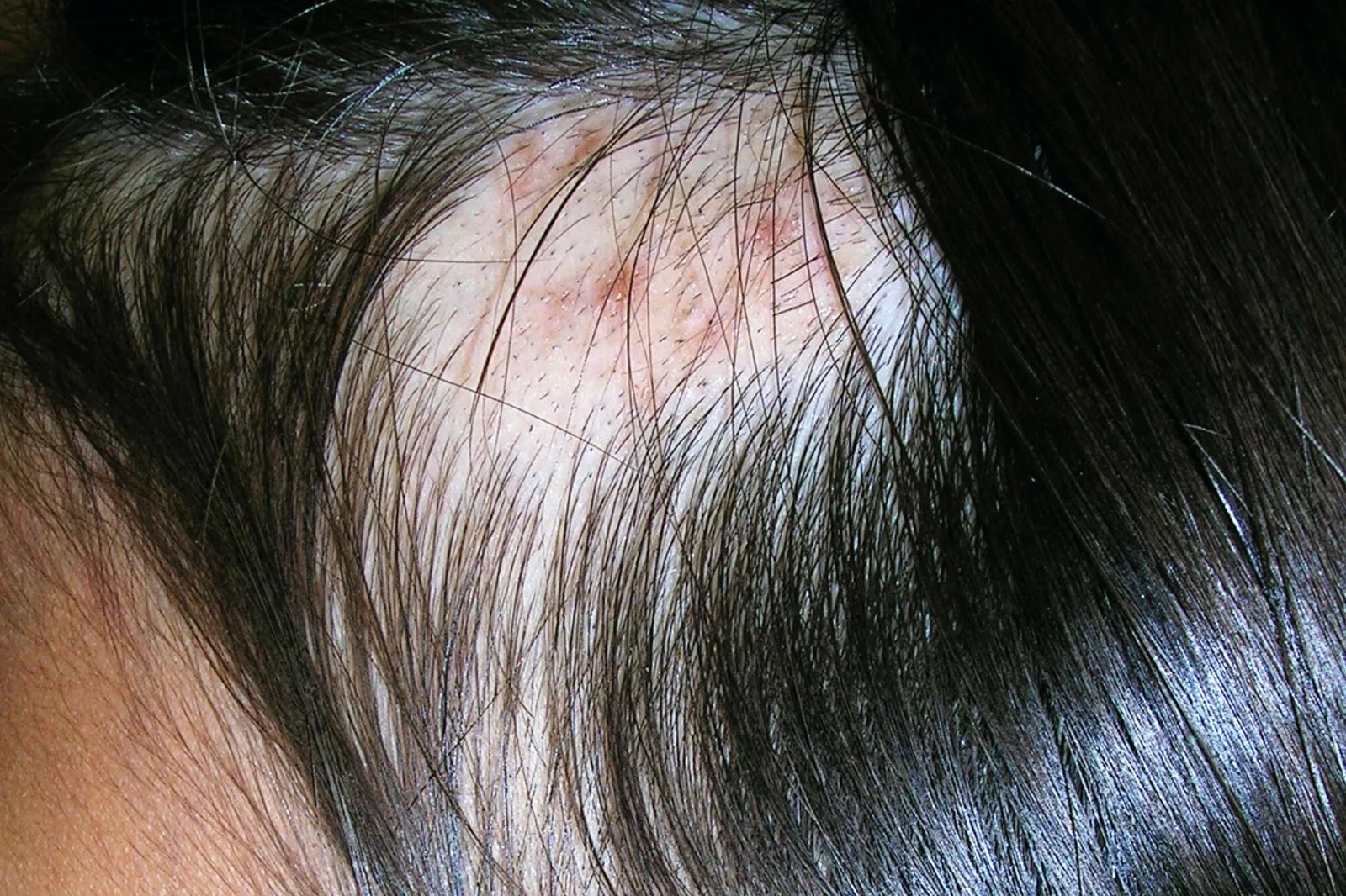 Trichotillomania (hair-pulling disorder)	