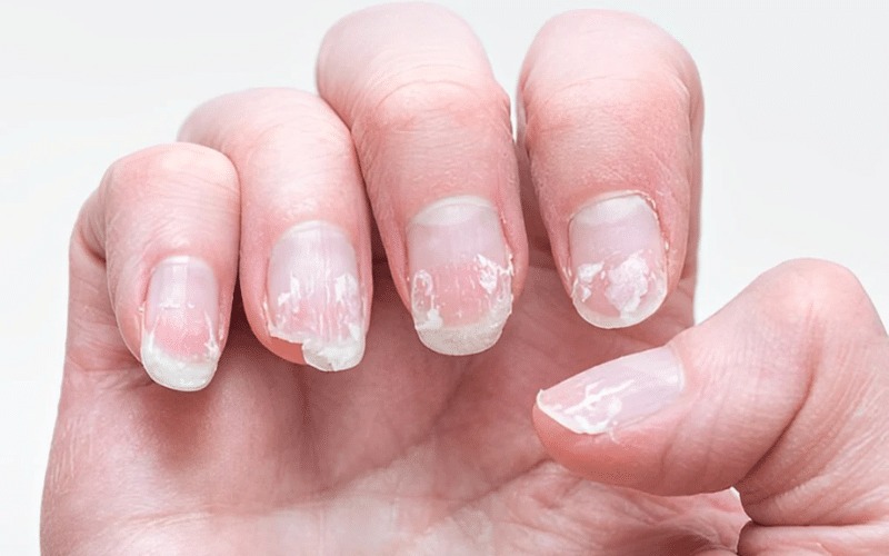 Nail Disorders