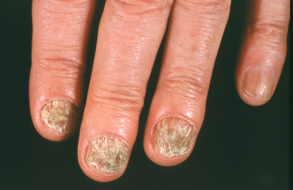 Onychomycosis (fungal nail infection)