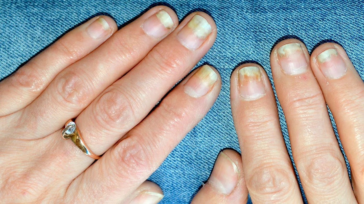 Psoriatic nail disease