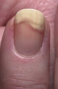 Onycholysis (nail separation)