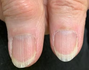 Onychoschizia (brittle nails)