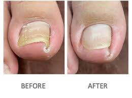 Ingrown toenail